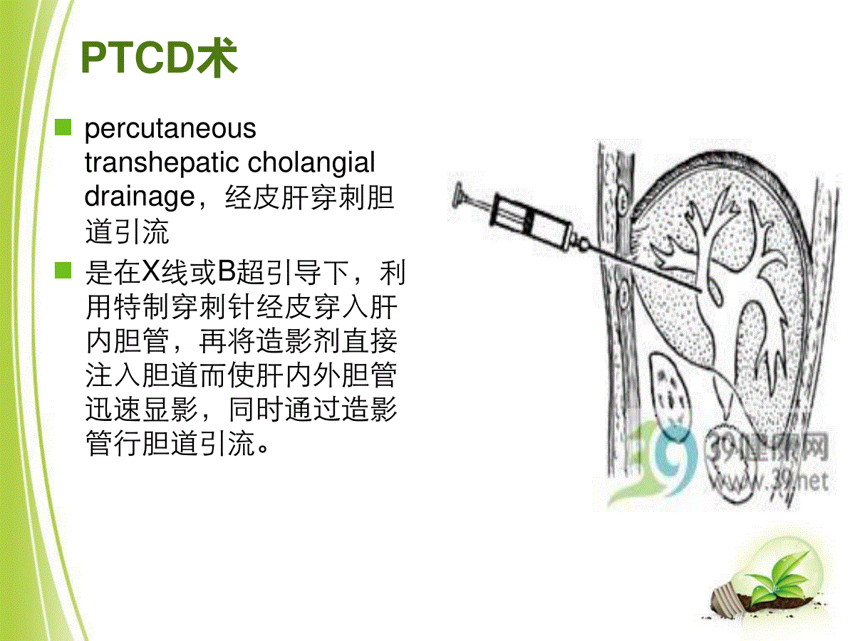 ptcd术